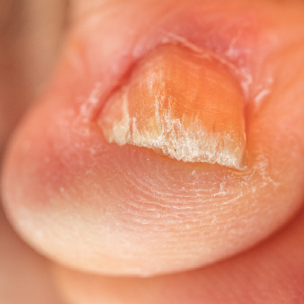 Een vorm van nagelpsoriasis aan een teen