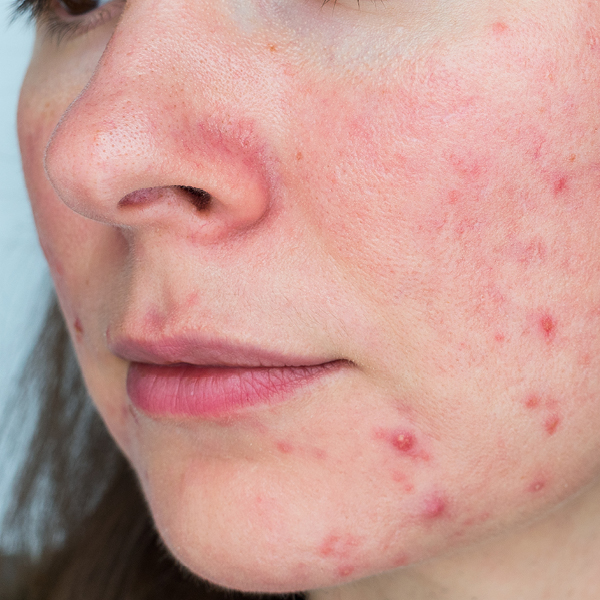 Sterke acne op een kaak