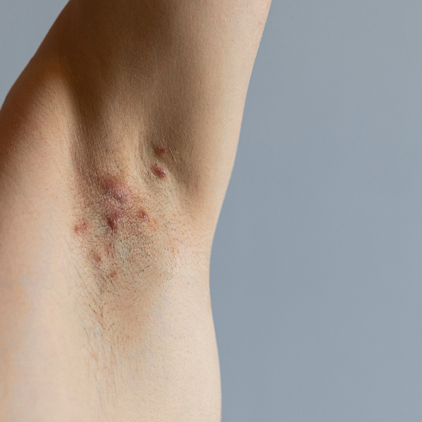 Acne inversa in de oksel