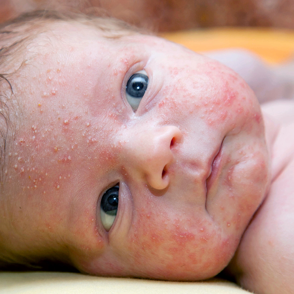 baby met acne(kleine bultjes) in het gezicht