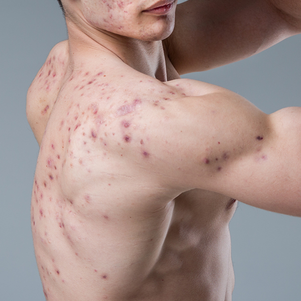 grote puisten op de rug van een jongeman