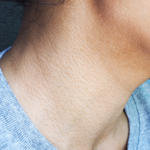 Keratosis pilaris op de hals