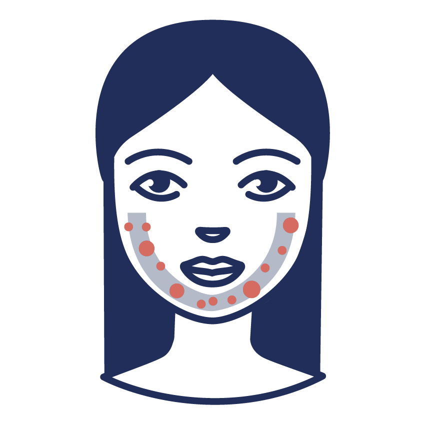 Afbeelding over acne in de U-zone