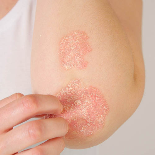 Detailfoto van psoriasis aan de elleboog