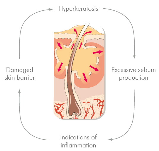 Scheme for the causes of acne