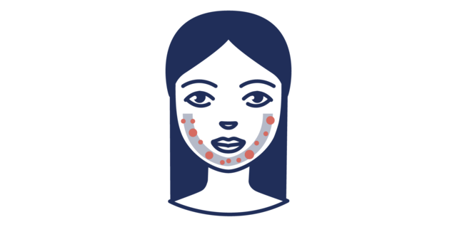 [Translate to Niederländisch:] Illustration der Acne tarda in der U-Zone