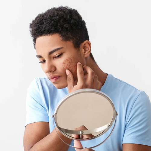 Een tiener bekijkt zijn acne in de spiegel