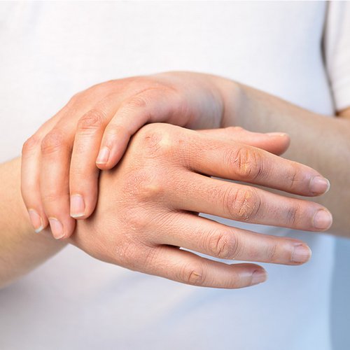 handen met schubbenziekte
