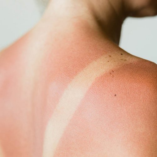 Schouder rood door zonnebrand