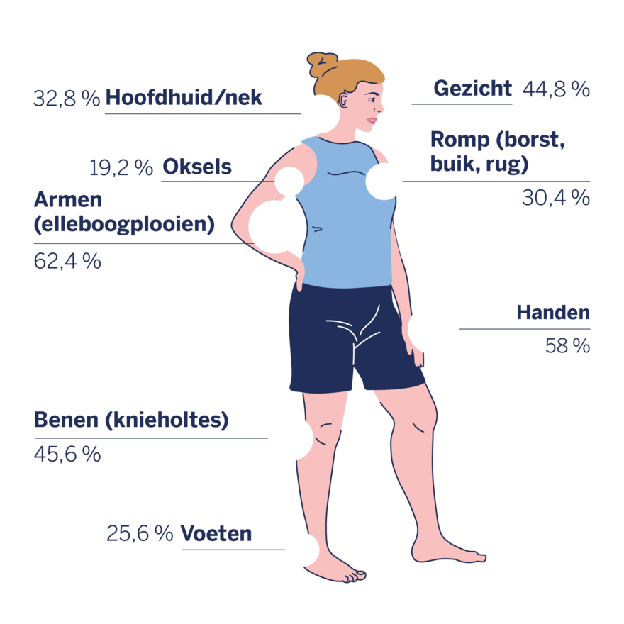 Plaatje van een vrouw en hoe vaak de symptomen voorkomen