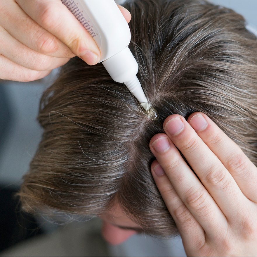 [Translate to Niederländisch:] Mann trägt Kopfhautpflege auf 