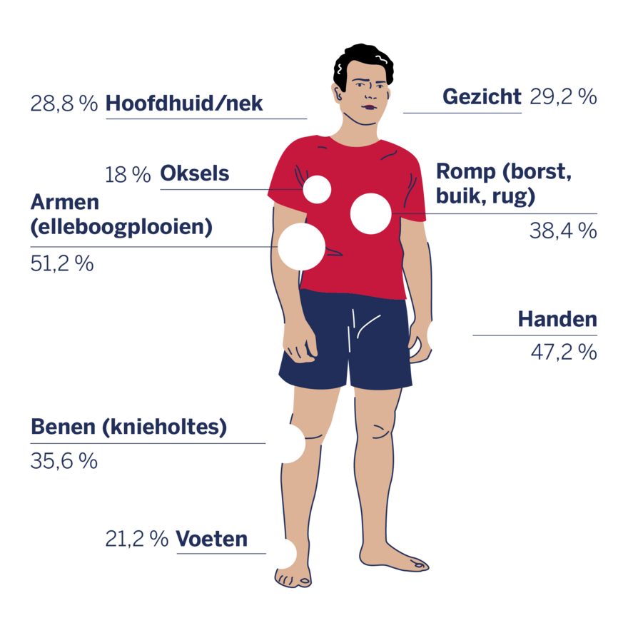 Plaatje van een man en hoe vaak de symptomen voorkomen