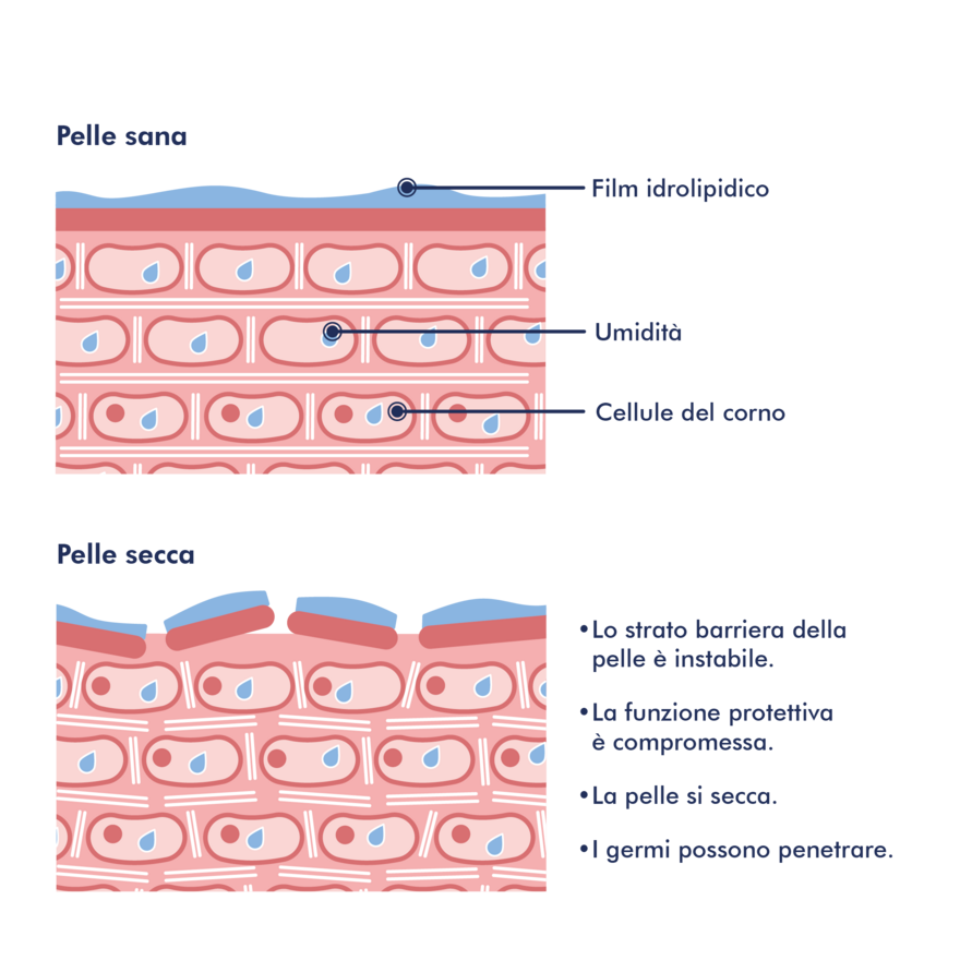 Immagine della pelle: Pelle con dermatite atopica