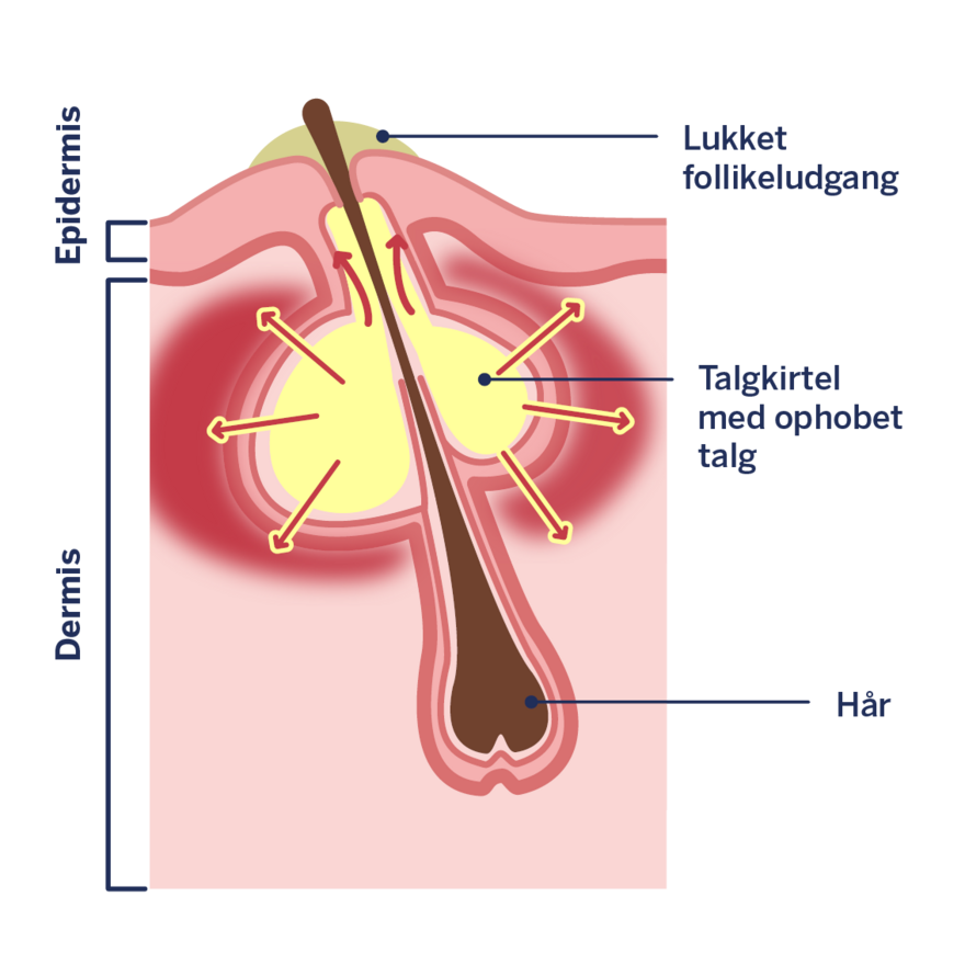 Infografik: Opståen af uren hud