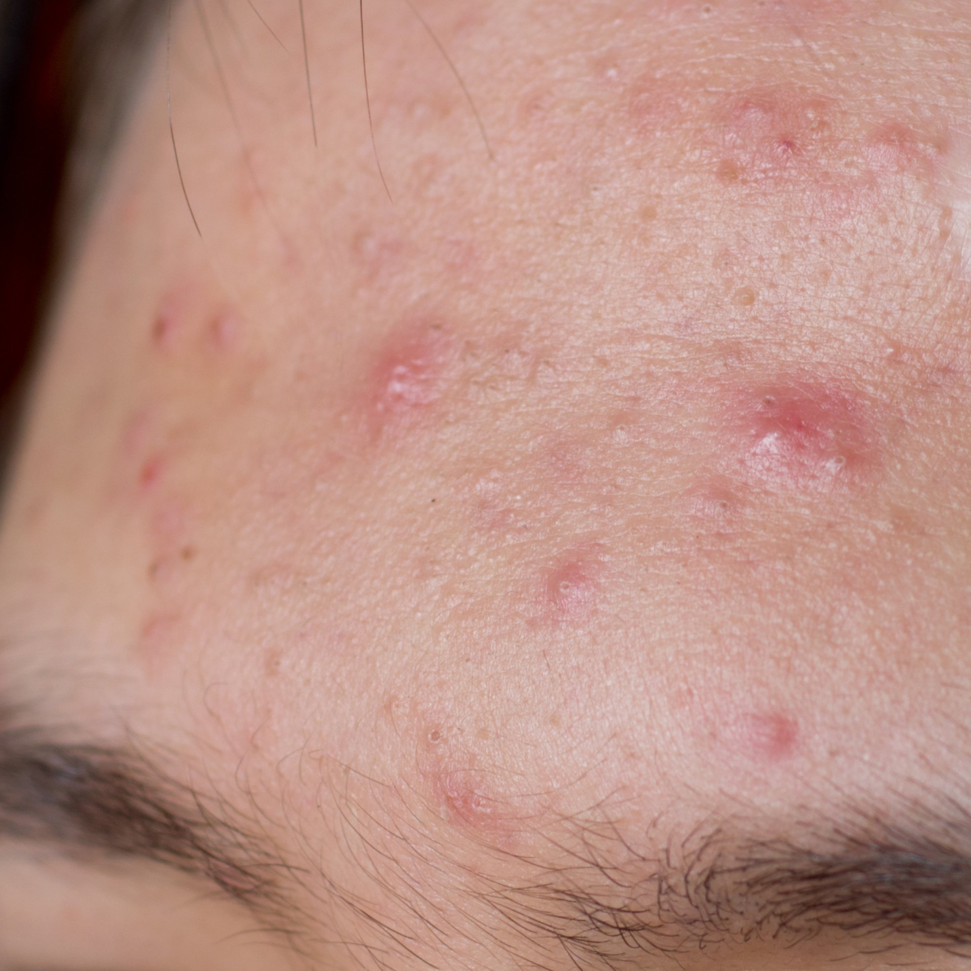 Acne op het voorhoofd