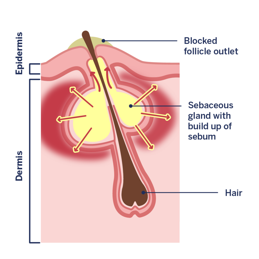 Infographic: Formation of a pimple