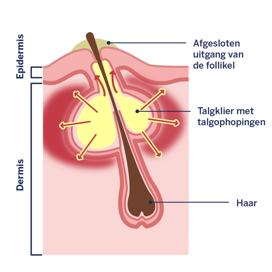 Infographic: Vorming van een puistje