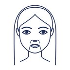 Neuslippenplooien en marionetlijnen