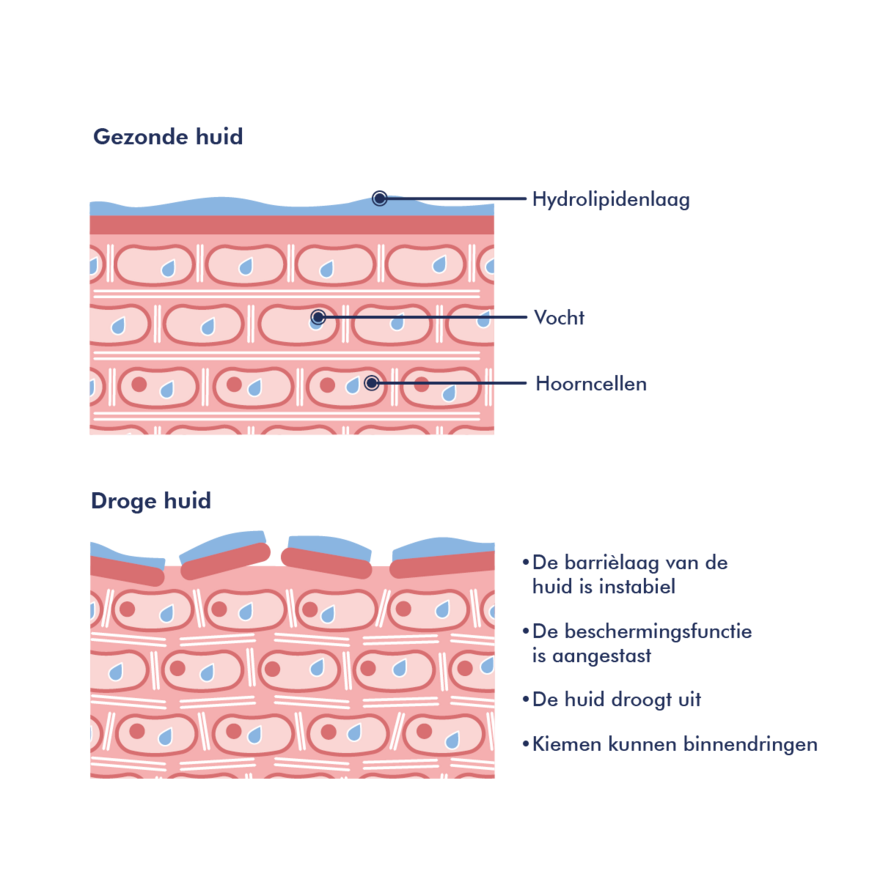 Symptomen van atopische huid zijn roodheid, droogheid en jeukerige gevoelens Huidafbeelding: atopische huid