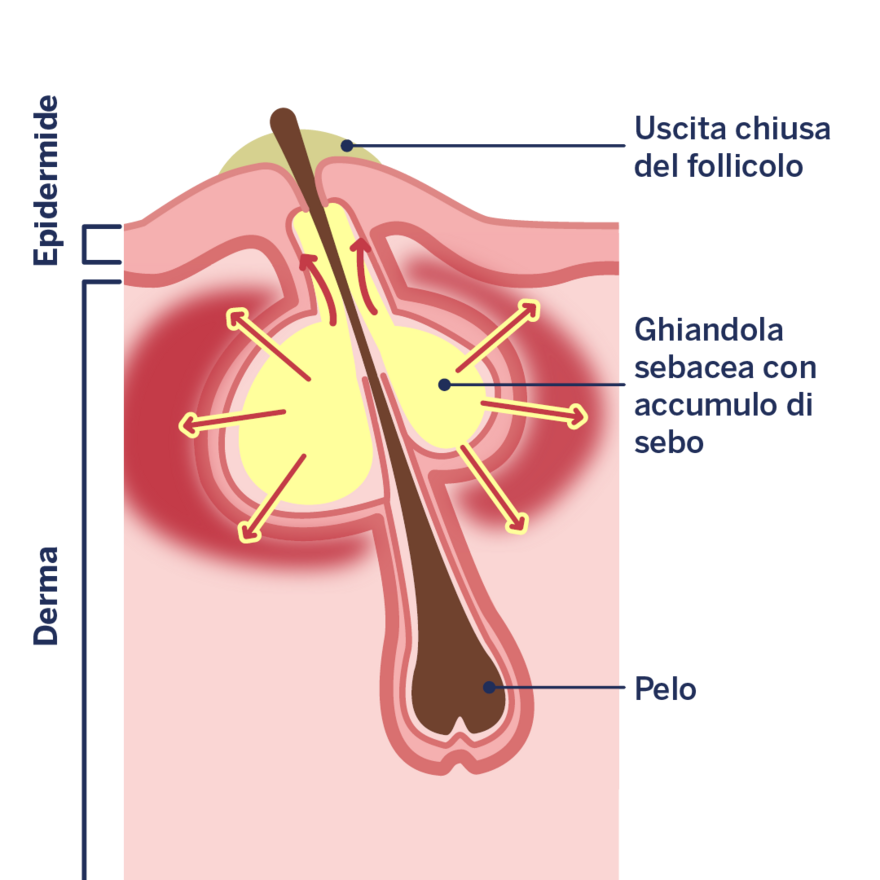 Infografica: Sviluppo di un brufolo