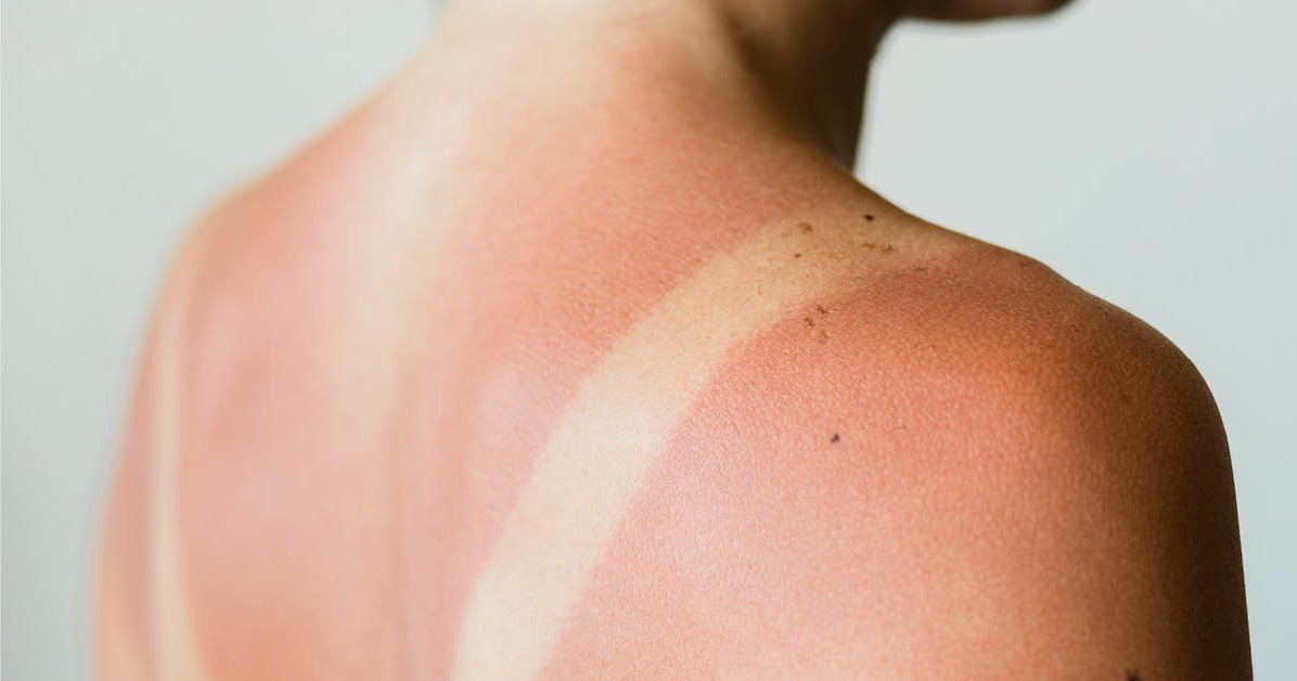 Verbrande huid - wat doen tegen zonnebrand?