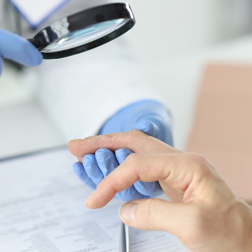 Arts onderzoekt de nagelpsoriasis van zijn patiënt