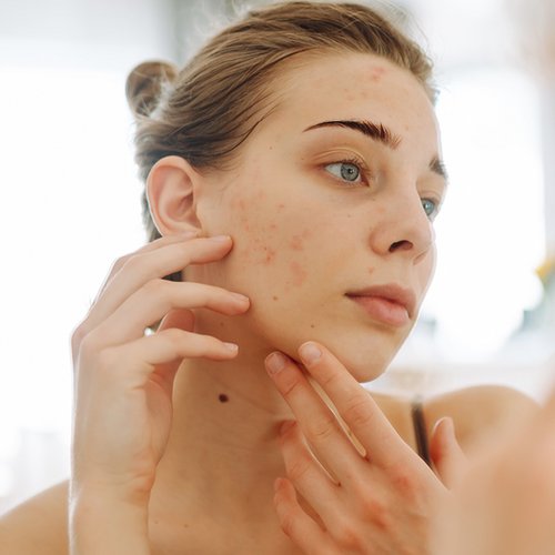 [Translate to Niederländisch:] Junge Frau untersucht ihre Haut im Spiegel.