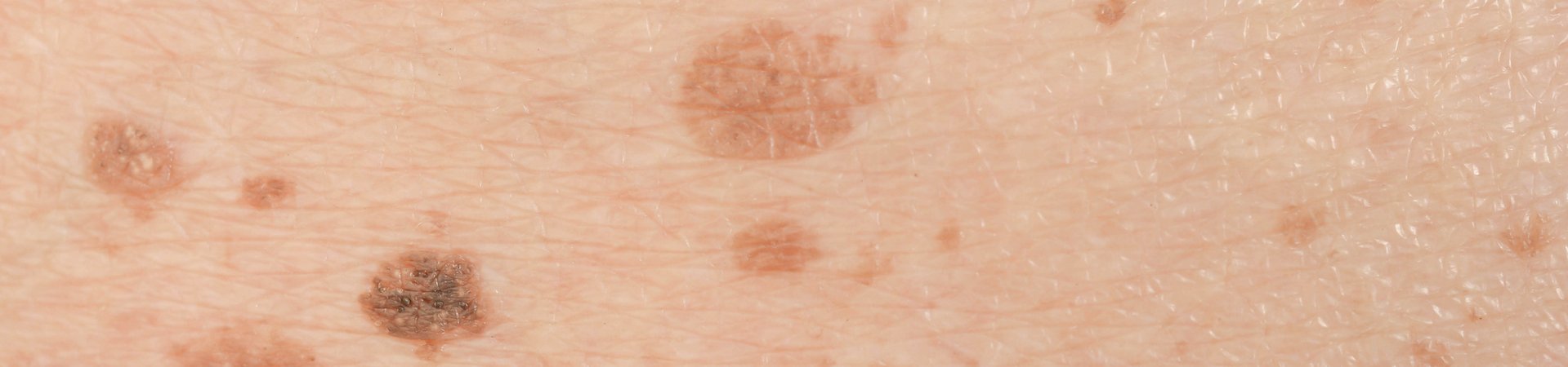Taches sur la peau