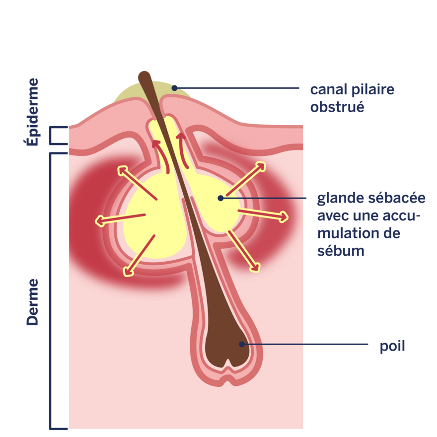 Infographie sur le sujet: Origine des impuretés cutanées
