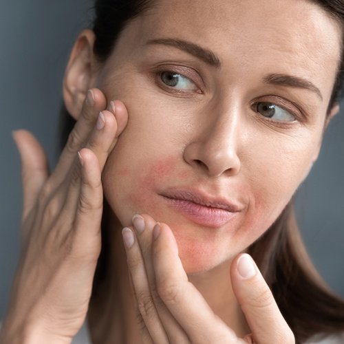 [Translate to Niederländisch:] Frau mit Perioraler Dermatitis