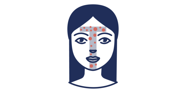 [Translate to Niederländisch:] Illustration der Acne vulgaris in der T-Zone