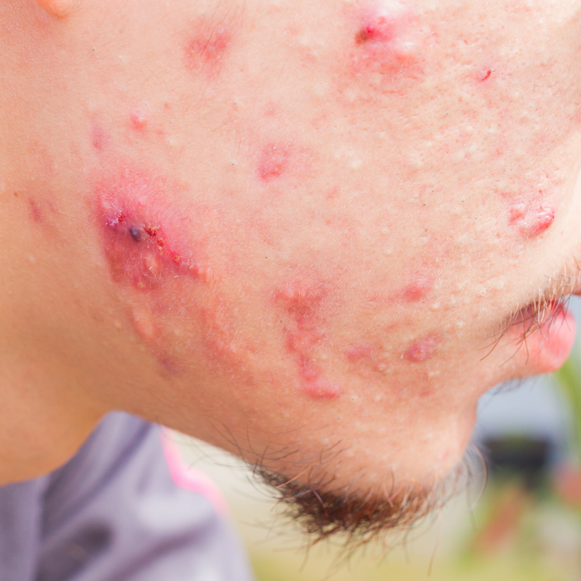 Ernstige acne op de wang