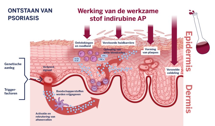 Grafische beschrijving van het onstaan van psoriasis