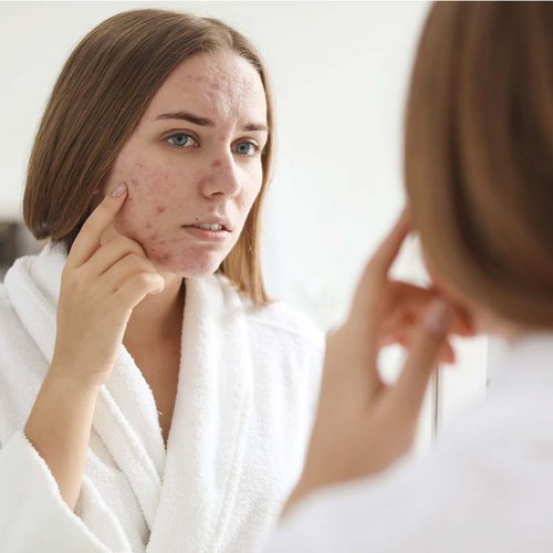 [Translate to Niederländisch:] Junge Frau mit Akne im Wangen- und Kinnbereich