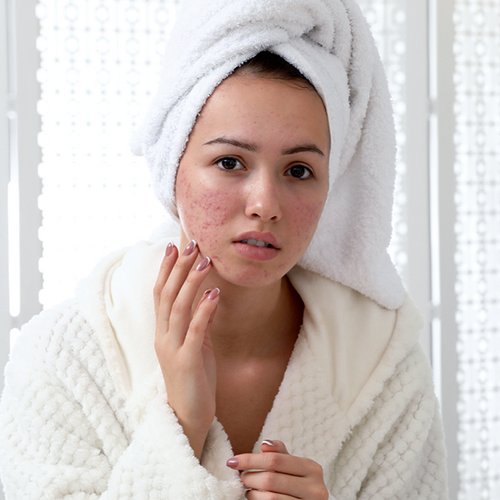 [Translate to Niederländisch:] Eine Frau betrachtet ihre Aknenarben auf der Wange im Spiegel.